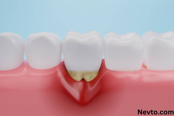How To Cure Gum Disease Without a Dentist?